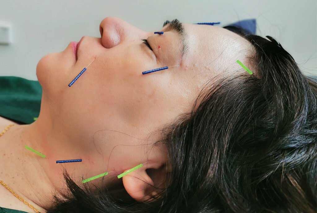 Experience the Miracle of Facial Rejuvenation with the Power of Facial Acupuncture